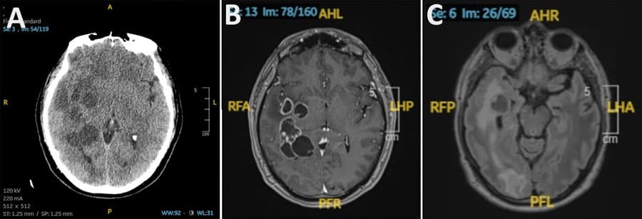 Brain Scan Mystery: When Parasites Mimic Cancer